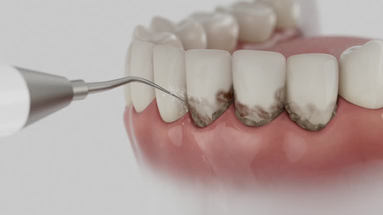 Trusted Wisdom Tooth Removal service in Totowa, NJ - Dentist Open Now